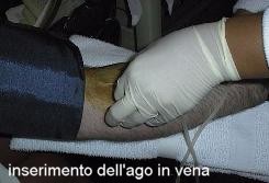 Inserimento dell'ago in vena